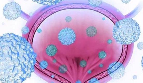 膀胱癌的疾病分類有哪些?膀胱癌的治療方法有哪些?