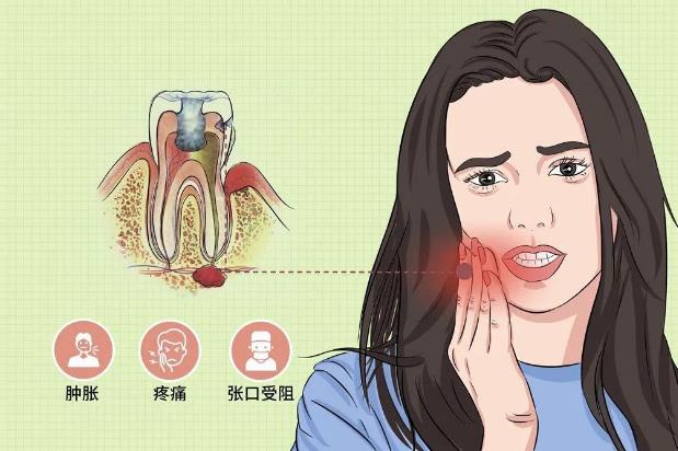 全民愛牙公益-智齒牙發炎有哪些炎癥呢