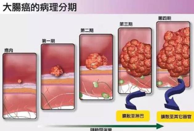 武漢漢西博仕肛腸醫院如廁三種表現或是腸道“長”息肉
