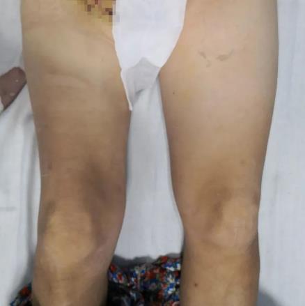 案例 大腿腫脹來勢洶洶,合川宏仁醫院醫生及時救治,消失匆匆!