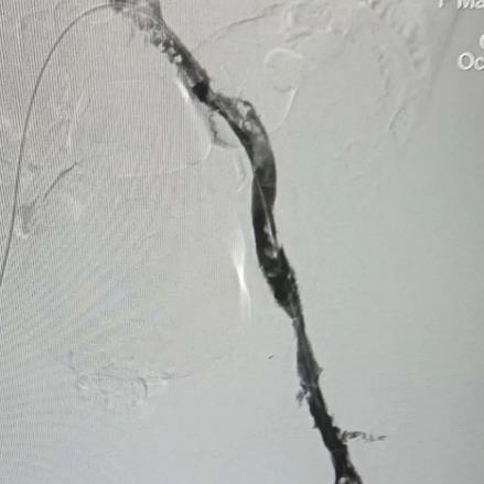 案例 大腿腫脹來勢洶洶,合川宏仁醫院醫生及時救治,消失匆匆!