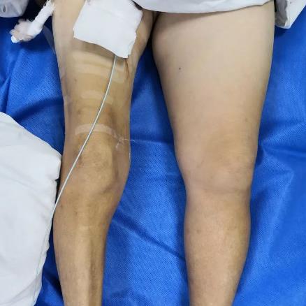 案例 大腿腫脹來勢洶洶,合川宏仁醫院醫生及時救治,消失匆匆!