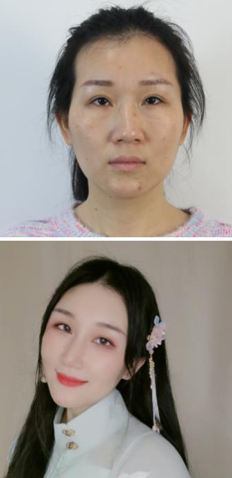 福州名韓整形徐麗麗:早點做脂肪膠填充的好處