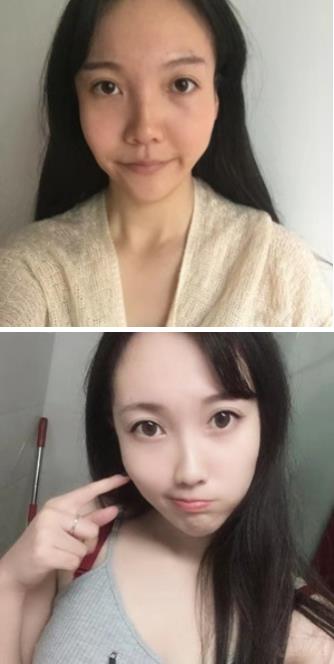 福州名韓整形徐麗麗:早點做脂肪膠填充的好處