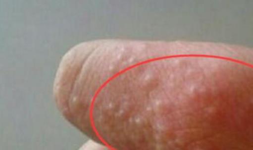 怎么預(yù)防手指長小水泡?手指脫皮的原因有哪些?