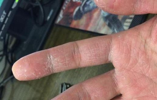 怎么預(yù)防手指長小水泡?手指脫皮的原因有哪些?