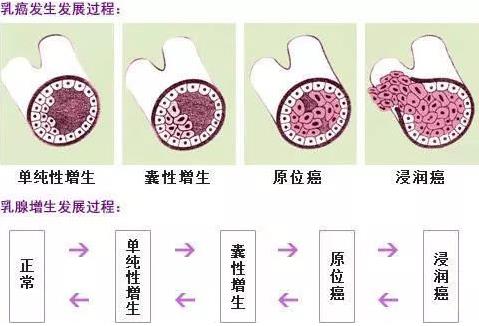 老婆乳腺增生,老公要怎么做才對?康蓓詩乳康冷敷貼讓我重獲健康!