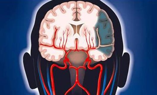腦血栓的早期癥狀是什么?腦血栓會引起哪些并發癥?