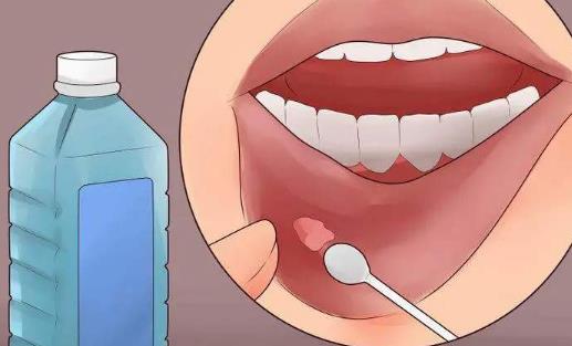 口腔潰瘍是怎么引起的?口腔潰瘍怎么辦?