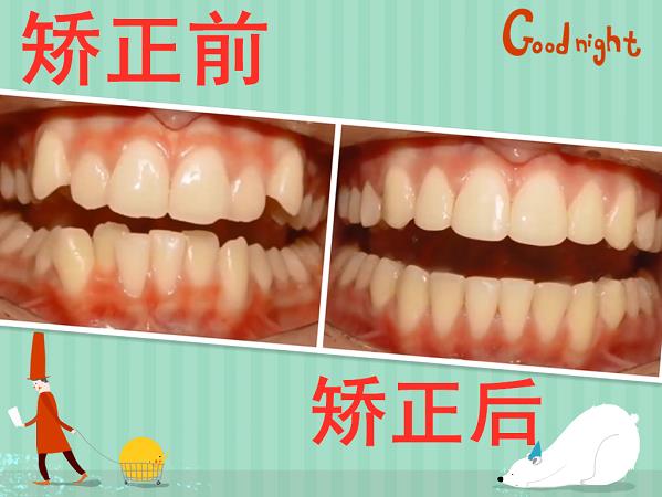 在昆明牙齒不齊怎么快速矯正?