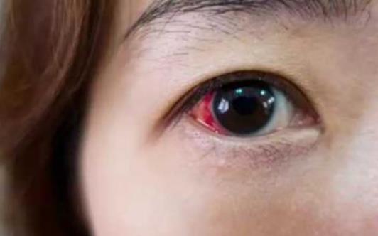 患前房積血的原因有哪些?前房積血的并發癥