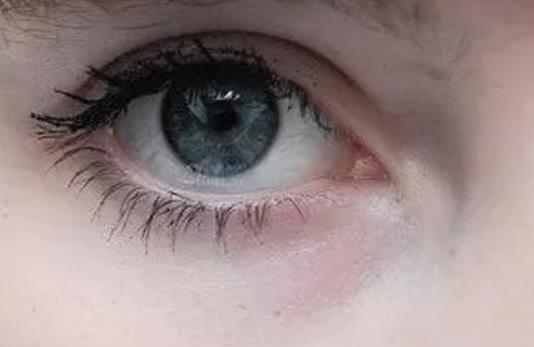 什么是泡性眼炎?泡性眼炎的疾病分類有哪些?