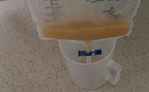 什么是乳糜尿?為什么會(huì)患乳糜尿?