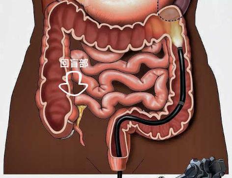 腸結(jié)核會(huì)傳染嗎?腸結(jié)核的癥狀是什么