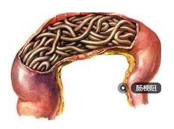 腸梗阻是怎么引起的?腸梗阻的癥狀是什么