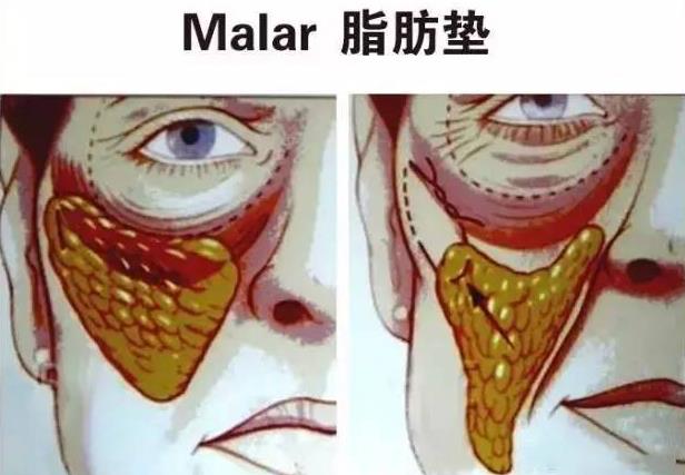 抗衰醫(yī)生宋超超:提升面部脂肪墊和SMAS筋膜層的優(yōu)勢