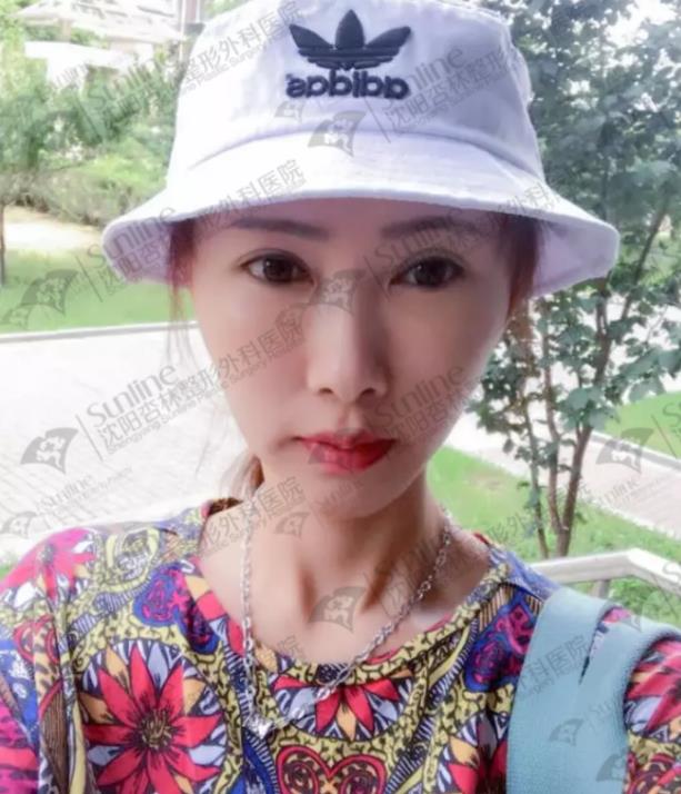 沈陽杏林整形醫院自體脂肪填充案例