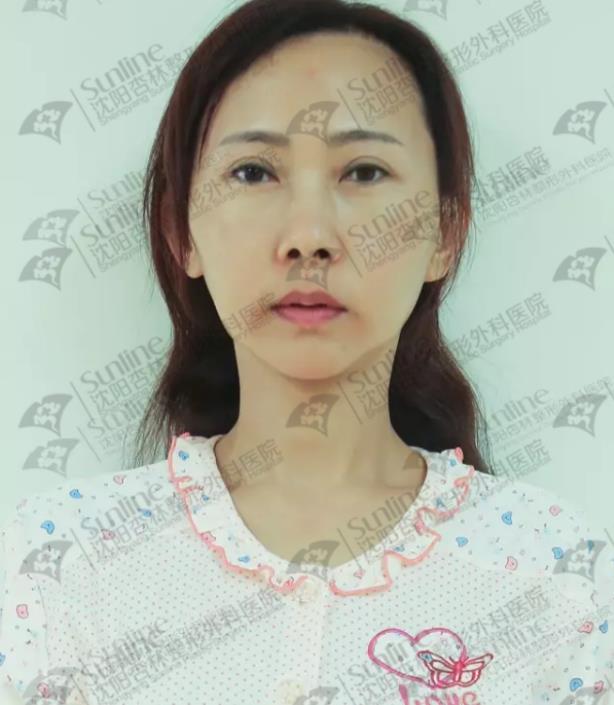 沈陽杏林整形醫院自體脂肪填充案例