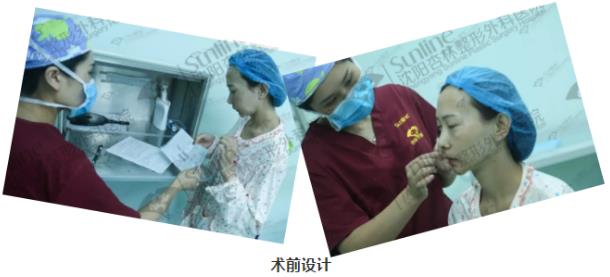 沈陽杏林整形醫院自體脂肪填充案例