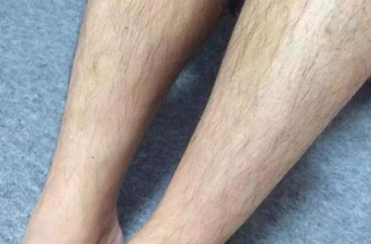 為什么會汗毛多?汗毛多可以怎么去除?