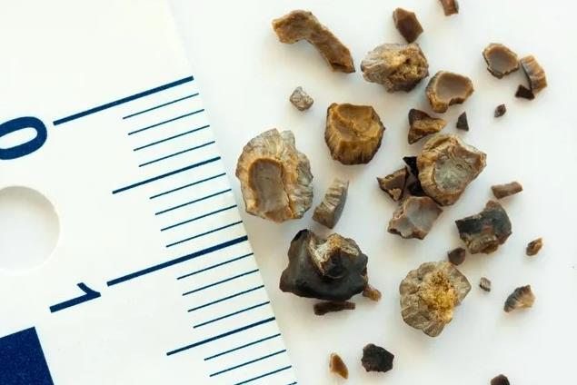 廣州治療腎結石比較好的醫院在哪里?廣州治療腎結石哪個醫生好?