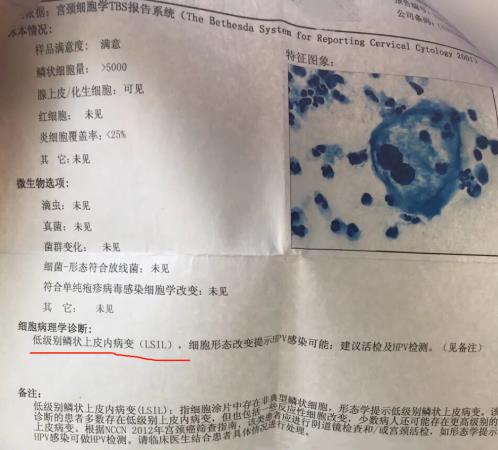 3個(gè)高危1個(gè)低危HPV感染,轉(zhuǎn)陰經(jīng)歷分享給大家