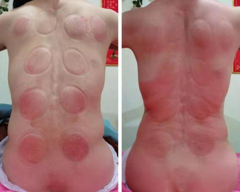 中國非遺徒手正骨傳承人肖玉華