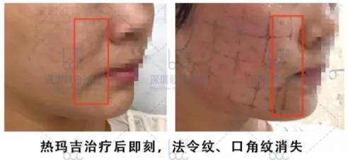 近20年臨床數據認證,熱瑪吉抗衰實力不是蓋的!