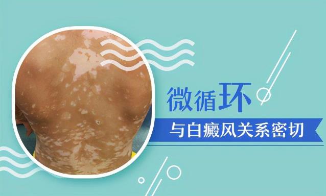 杭州華研白癜風(fēng)醫(yī)院好嗎?白癜風(fēng)罪魁禍?zhǔn)资撬!早發(fā)現(xiàn)早改善,祛白更快!