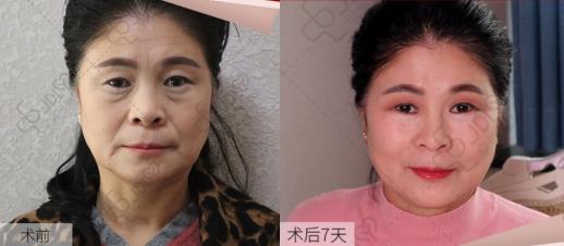 京典麗園去眼袋認(rèn)為:眼袋如果放任不管,加重眼袋下垂!