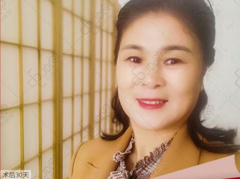 京典麗園去眼袋認(rèn)為:眼袋如果放任不管,加重眼袋下垂!