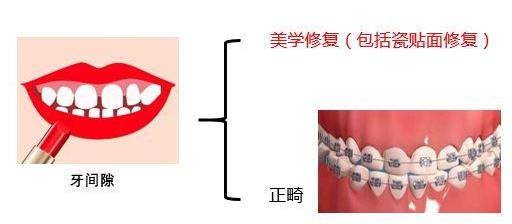 廣東省全民愛牙行動 給大家講一下瓷貼面美學修復~