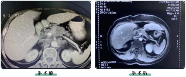 浙江腫瘤醫院推薦廣州復大腫瘤醫院:胰腺癌患者的新生機