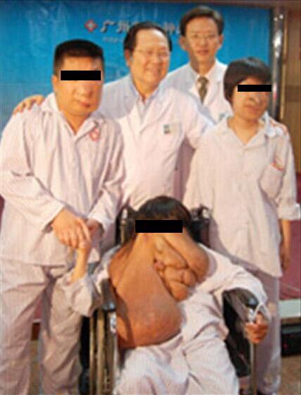 貴州腫瘤醫(yī)院哪家好,黃春才成功治療案例