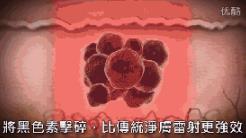 蜂巢皮秒祛斑是什么原理?江門(mén)夢(mèng)想整形醫(yī)院電話,江門(mén)夢(mèng)想整形技術(shù)好嗎