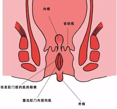 呼市東大醫(yī)院 出現(xiàn)這個癥狀,小心肛門不保