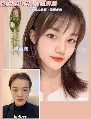 鄭州美萊隆鼻技術怎么樣 精湛技藝 附真人隆鼻案例對比