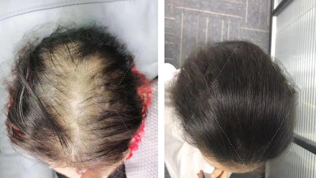 面對頭發稀疏怎么辦?日輕絲輕增發技術來幫忙