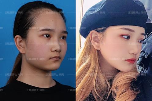 聯合麗格第一醫醫院顱頜面整形王瑞晨:下頜角留角or不留角?