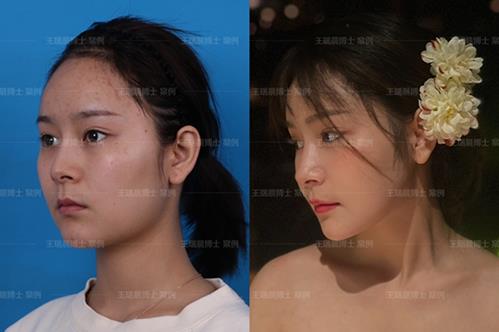 聯合麗格第一醫醫院顱頜面整形王瑞晨:下頜角留角or不留角?