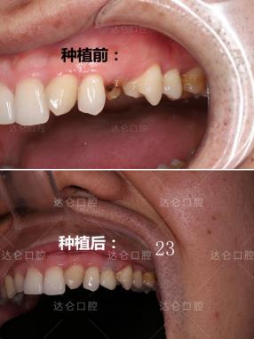 杭州種植牙十大高頻疑問(wèn),專(zhuān)業(yè)種植牙醫(yī)生一對(duì)一解答