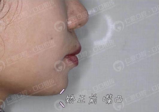 年齡大了還能矯正嗎?武漢仁愛口腔醫(yī)師告訴你可以