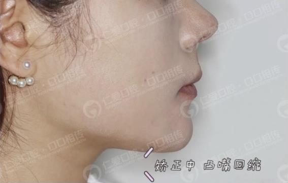 年齡大了還能矯正嗎?武漢仁愛口腔醫(yī)師告訴你可以