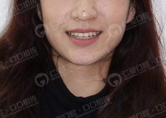 年齡大了還能矯正嗎?武漢仁愛口腔醫(yī)師告訴你可以
