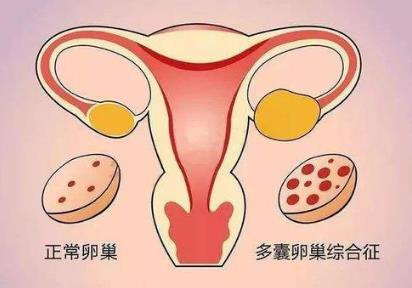 新陽(yáng)光生殖健康研究中心多囊卵巢綜合癥要怎么檢查?