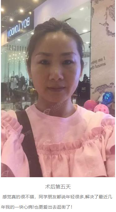 眼袋是怎么形成的,沈陽杏林整形做眼袋多少錢