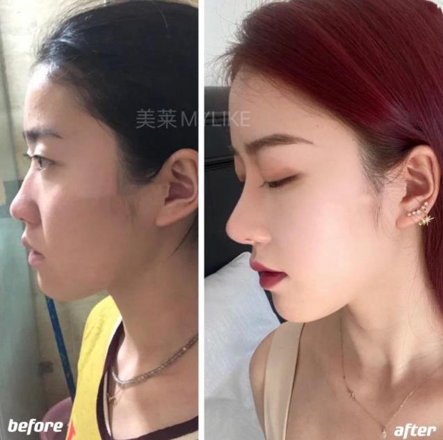 鄭州美萊醫院正規嗎 資質齊全 正規可靠改善鼻部缺陷 打造立體美鼻