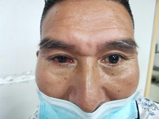 以吾之黑暗換汝之光明 男子因眼疾被迫摘眼球 捐獻眼角膜傳遞光明