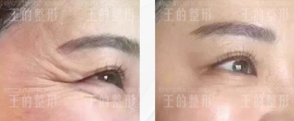 趕走皺紋,王海木院長說這些方法足夠了