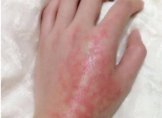 被水燙傷第一時間怎么處理?手上燙紅了會不會留疤
